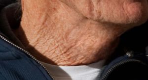 How to fix crepey skin on neck